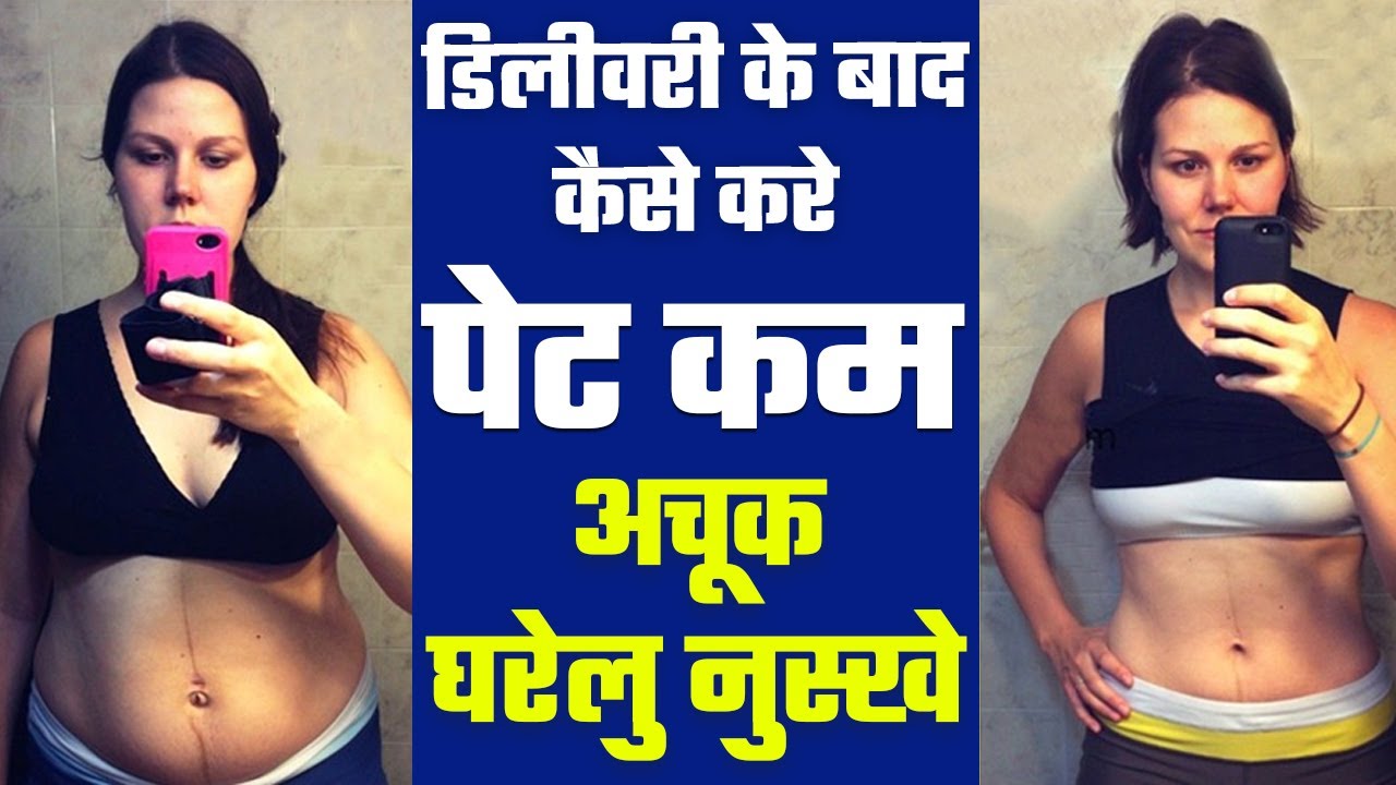 Delivery ke baad pet kaise kam kare Cesarean Delivery ke baad pet