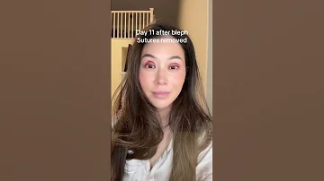Watch Me Recover From Eyelid Surgery Bleph Upperbleph Eyelidsurgery Eyesurgery Dentist 