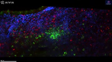 3D Visualization of TLS in Colorectal Tumor Tissue