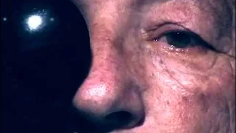 Fourth (4th) Cranial Nerve Palsy