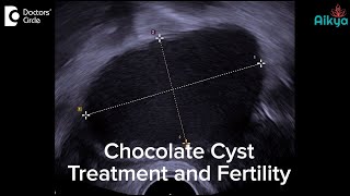 Chocolate Cyst Treatment and Fertility - Dr. Sunil Eshwar