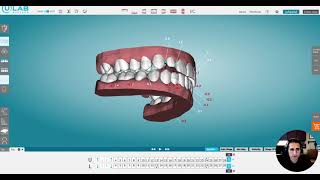 uLab #2: Chairside Refinement Software Tutorial: Fixing Posterior Crossbite and Rotated Teeth