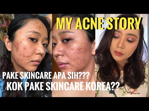 BEST SKINCARE PRODUCTS Buat JERAWAT (Acne). 