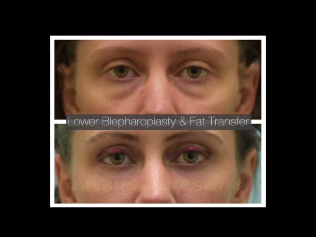 Dallas Fat Transfer and Lower Blepharoplasty Before and After