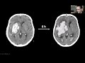 The eans webinar intracerebral hemorrhage  neurosurgical treatment perspectives