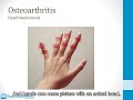 14.3.5 Osteoarthritis 