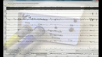 R-peak Detection with VU-DAMS