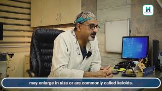 Ear Keloid : Causes and Treatment - Dr. Raman Abrol