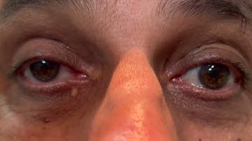 Progressive Supranuclear Palsy (PSP)