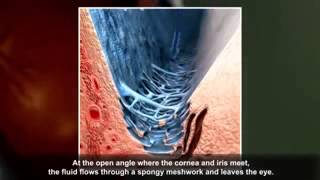 Glaucoma animation