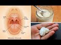 3 Powerful Home Remedies for Tonsil Stones That Work Fast! (Tonsilloliths)