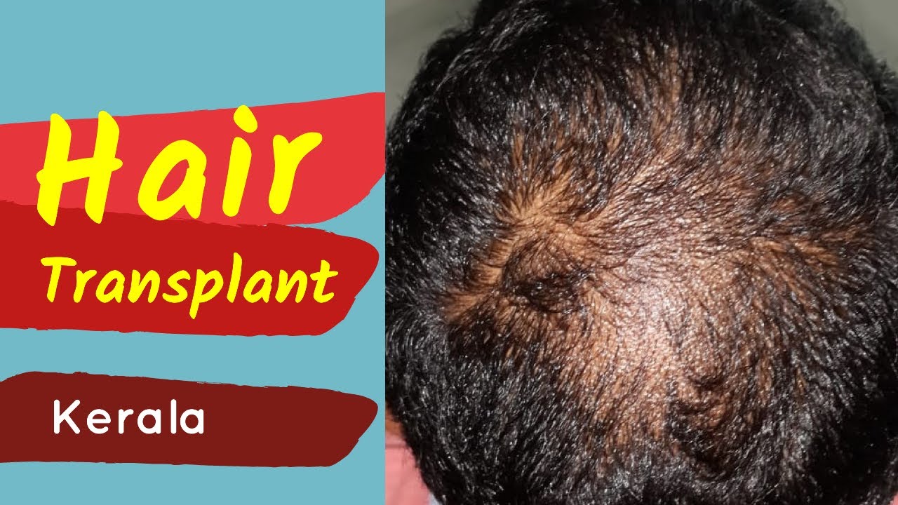 Hair Transplant in Kerala Best & Cost effective Hair Transplant Clinic in Kerala YouTube