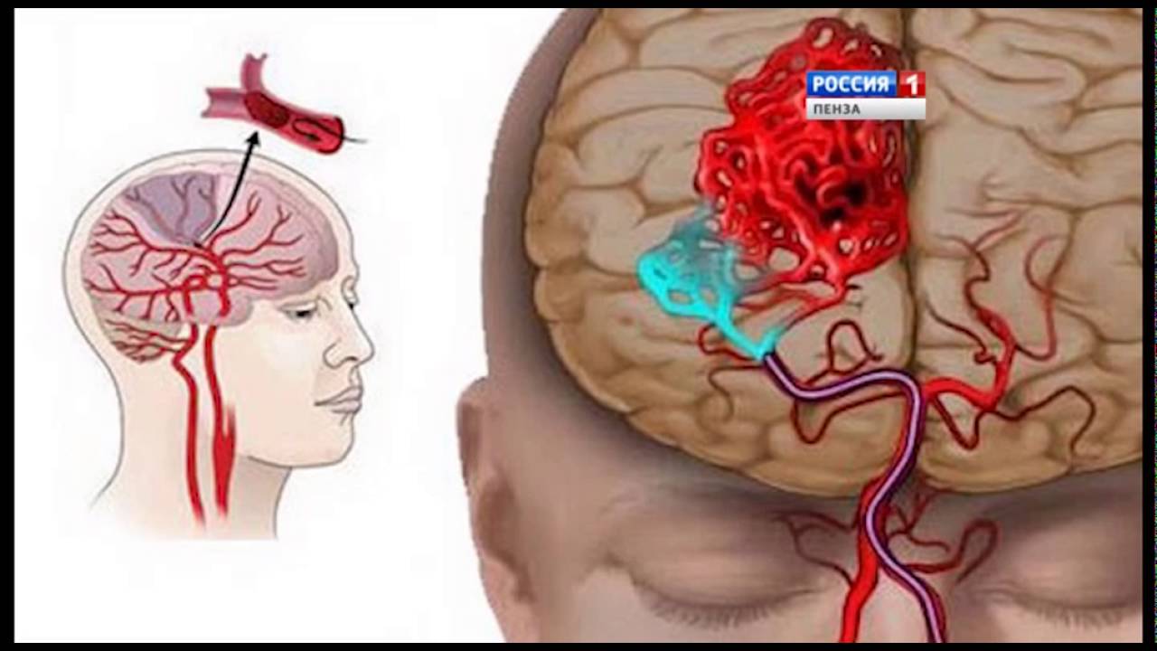 Проблемы с мозгами симптомы. Ишемический инсульт сосудов головного мозга. Тромбоэмболия сосудов головного мозга. Ишемический инсульт поражения артерий.