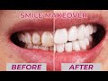 Total mouth restoration with porcelain veneers  minimal preparation dental boutique