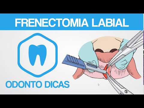 FRENECTOMIA LABIAL | ODONTO DICAS