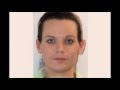 Facial Feminization Surgery Before / After - Marcelo Di Maggio