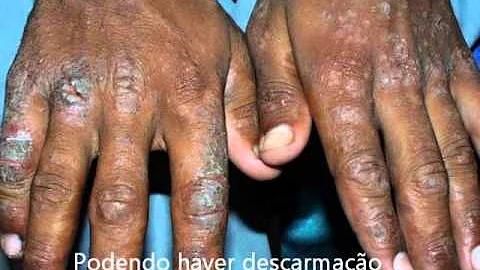 Como curar ferimento de cimento?