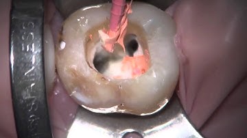 GuttaCore Carrier Placement | Dentsply Sirona