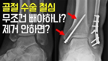 발목 골절 수술 후 철심 제거해 말어