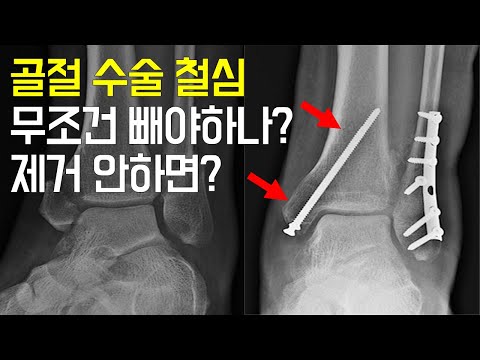 발목 골절 수술 후 철심 제거해 말어