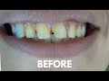 Front teeth crowns  quick smile transformation with crowns pfm dentalesthetics