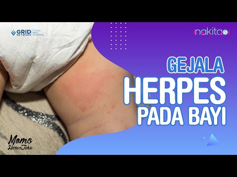 Video: Cara Menyembuhkan Herpes Pada Kanak-kanak