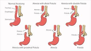 Esophageal Atresia  What is Esophageal Atresia