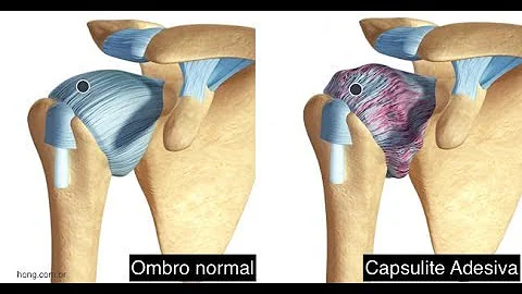 Quanto tempo leva para curar capsulite adesiva?