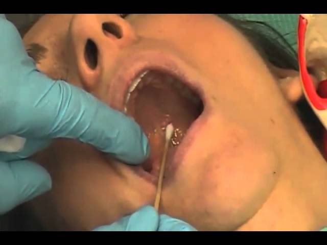 Greater palatine nerve block