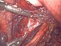 Ureteric dissection in parametrial endometriosis  narration 