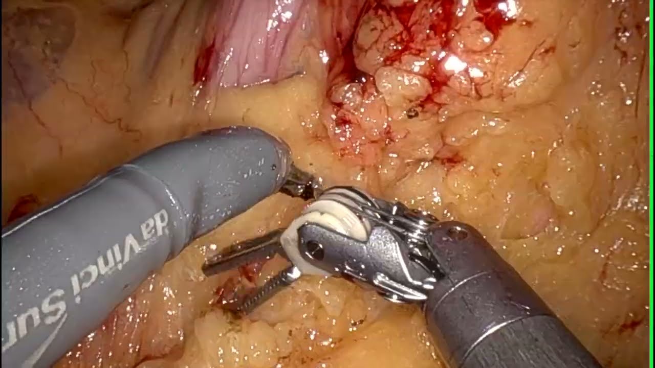 robotic assisted total Gastrectomy for gastric cancer
