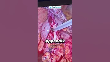 Appendix ka operation kaise hota hai ? Appendicitis Treatment I Appendix ka ilaj I Appendix bimari