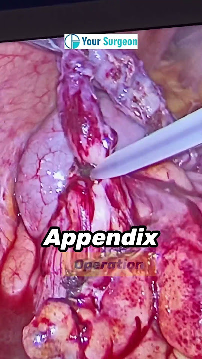Appendix ka operation kaise hota hai ? Appendicitis Treatment I Appendix ka ilaj I Appendix bimari