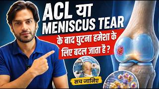ACL या Meniscus Tear के बाद घुटना हमेशा के लिए बदल जाता है? सच जानिए #aclrecovery #acltear