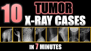 10 Tumor X Ray Cases in 7 minutes #radiology #bones #doctor