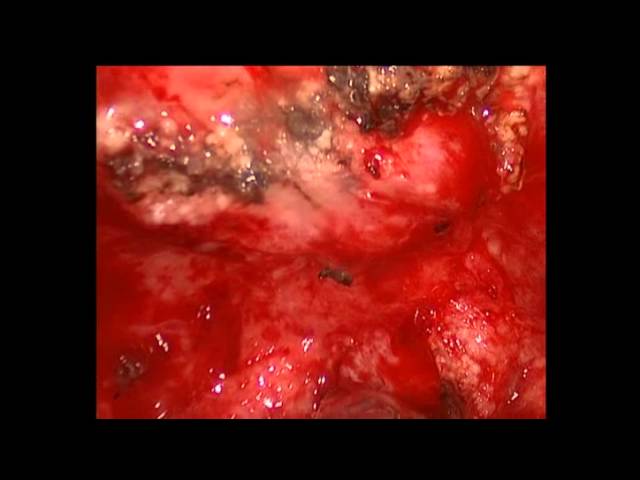 Туберкулез плевры, легкого - торакоскопия. Thoracoscopy tuberculosis lung and pleura