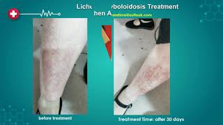 Amyloidosis  Treatment Case Study Updated 2022
