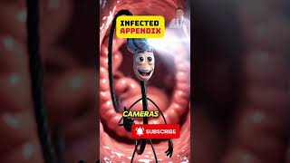 What Happens During Surgery for a Burst Appendix? - Dr Trieu