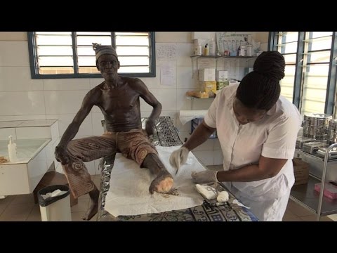 Video: ¿Se ha curado la lepra?