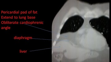 CASE 228 PEROCARDIAL FAT PAD CT