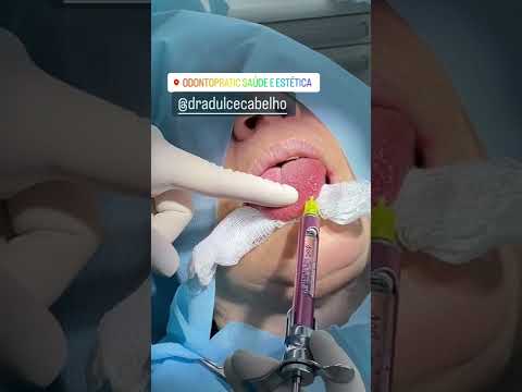 Vídeo: As fissuras na língua são dolorosas?