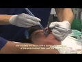 Intubation Extubation 4/7