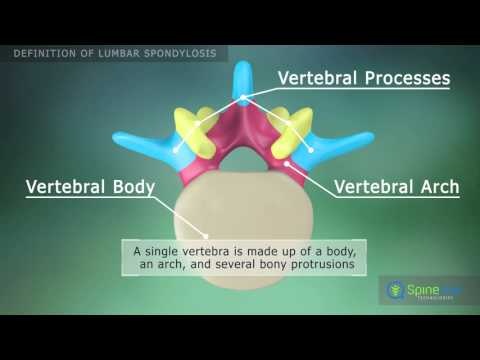 Lumbar Spondylosis. Definition