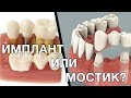 Имплант или зубной мостик. Что лучше выбрать? Имплантация зубов. Мост зубной.