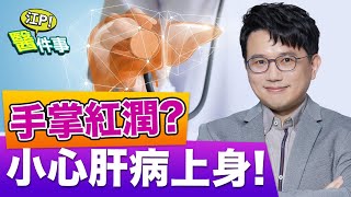 肝臟出問題大症狀小心肝病上身肝掌 蜘蛛痣 黃疸 怎麼看【江P醫件事#76】