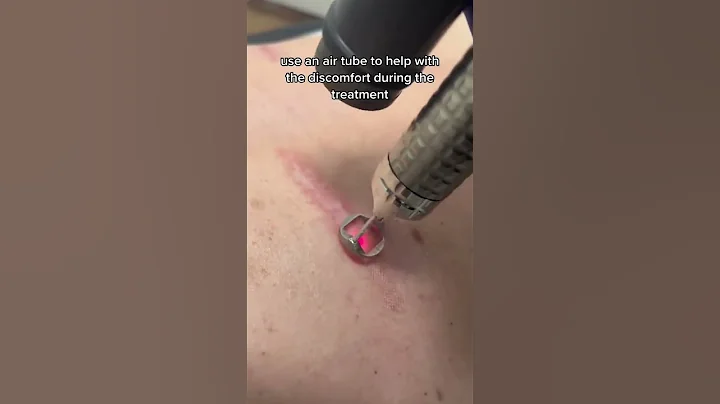 Laser Scar Removal - DayDayNews