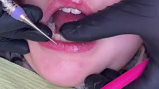 What is a Smoo Dental Instrument? by Hygiene Edge 4,604 views 4 months ago 47 seconds