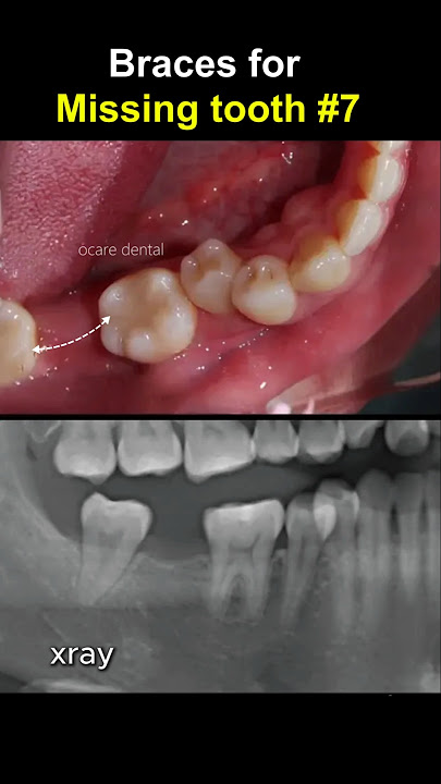 Braces for teeth missing tooth number 7. #braces #dentist #orthodontist