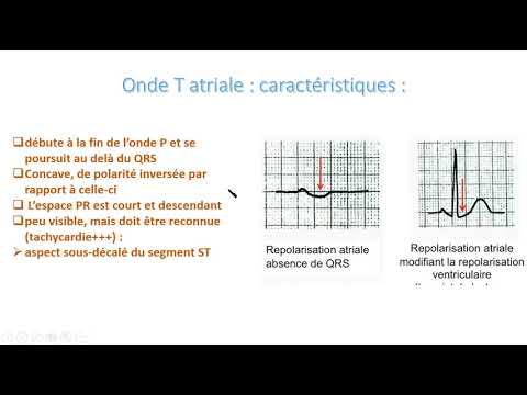 Vidéo: Qu'est-ce que la dépression du segment s-t ?