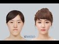 Operasi Plastik Korea Sebelum dan Sesudah [Let Me In Korea TV Show] - Indonesia Subtitle